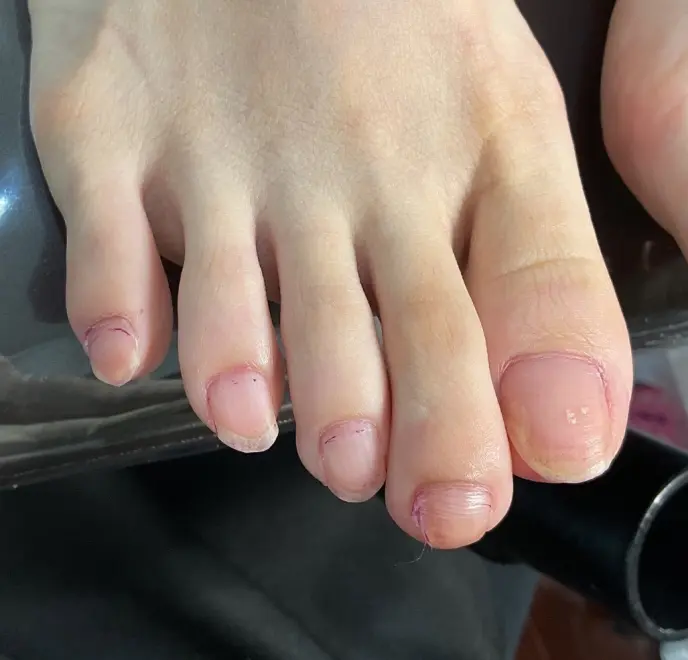 佐倉巻き爪サロン ルポ症例写真 爪ケアBefore