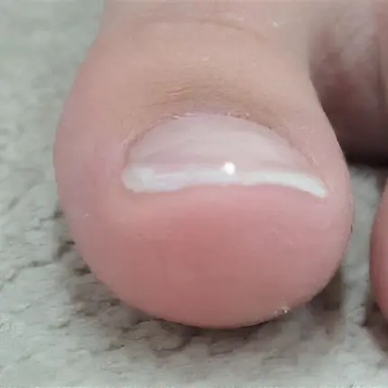 佐倉巻き爪サロン ルポ症例写真 巻き爪補正After