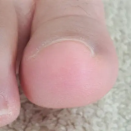 佐倉巻き爪サロン ルポ症例写真 巻き爪補正Before