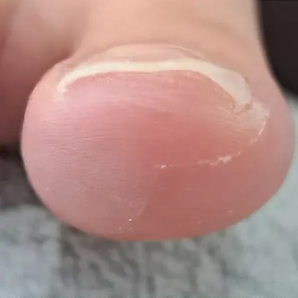 佐倉巻き爪サロン ルポ症例写真 巻き爪補正After