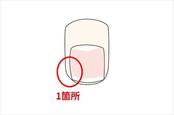巻き爪料金表の「1箇所」の数え方